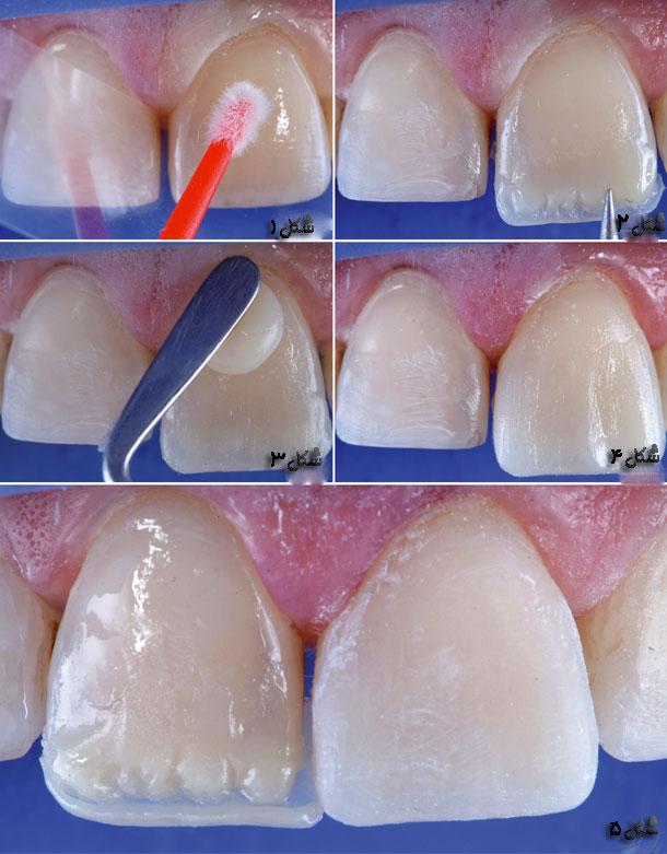 کامپوزیت دندان - دکتر شیرین مددی