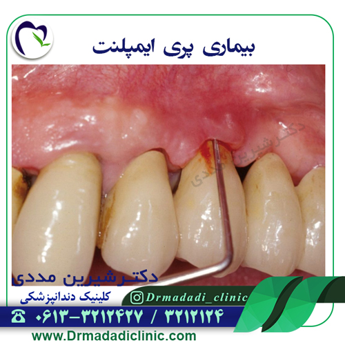بیماری های ایمپلنت دندان