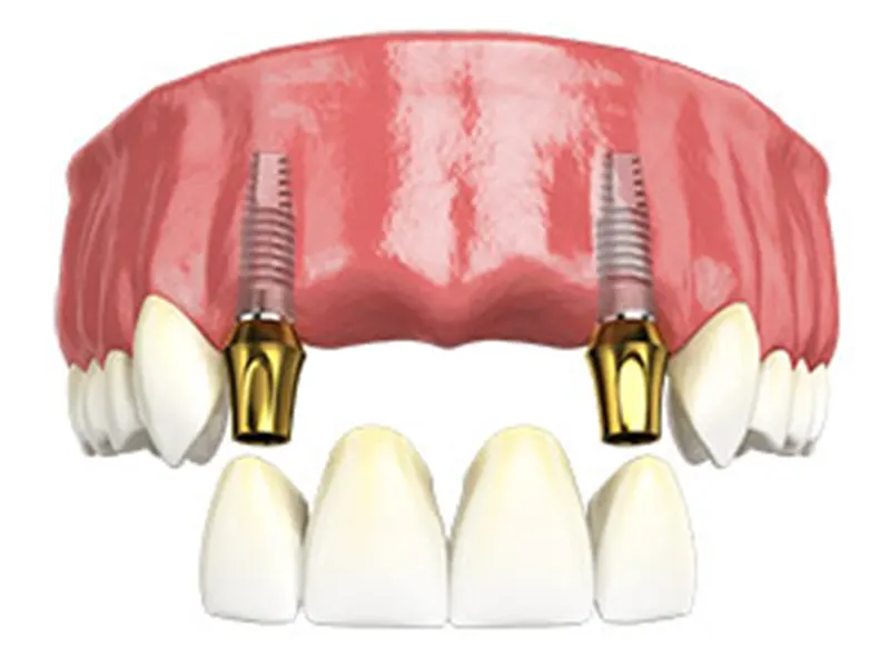 ایمپلنت دندان جلو