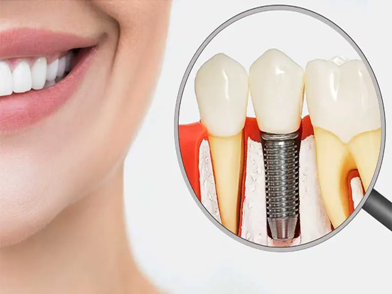 بهترین متخصص ایمپلنت در اهواز