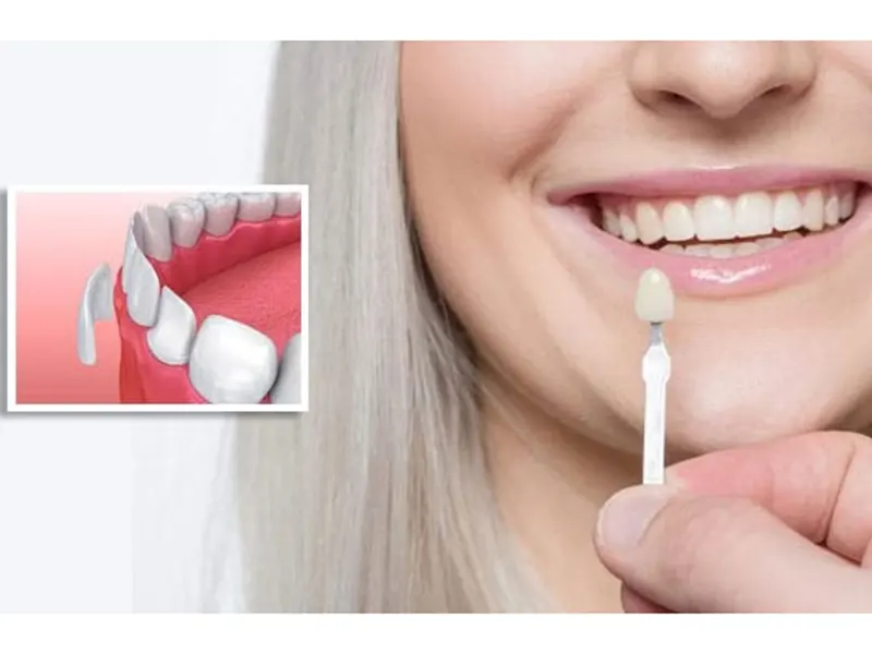 ترمیم لمینت دندان