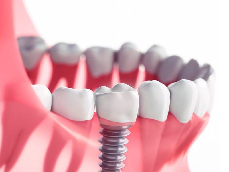 ایمپلنت بدون درد و خونریزی