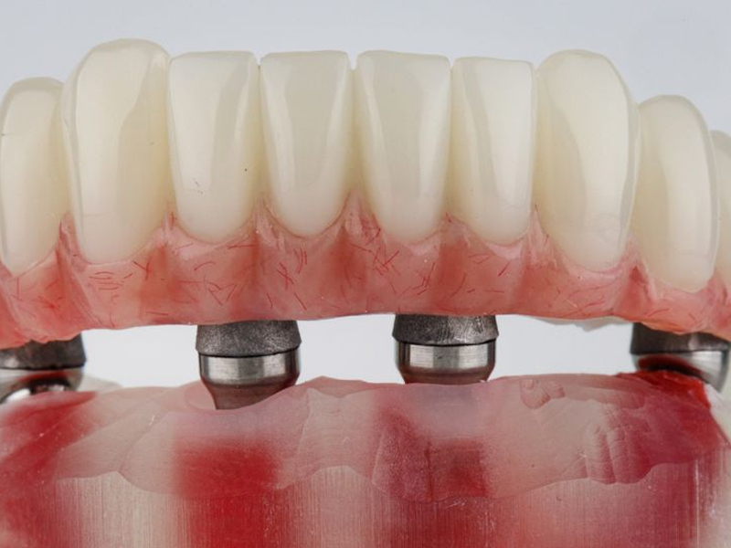 ایمپلنت ثابت و متحرک چیست؟