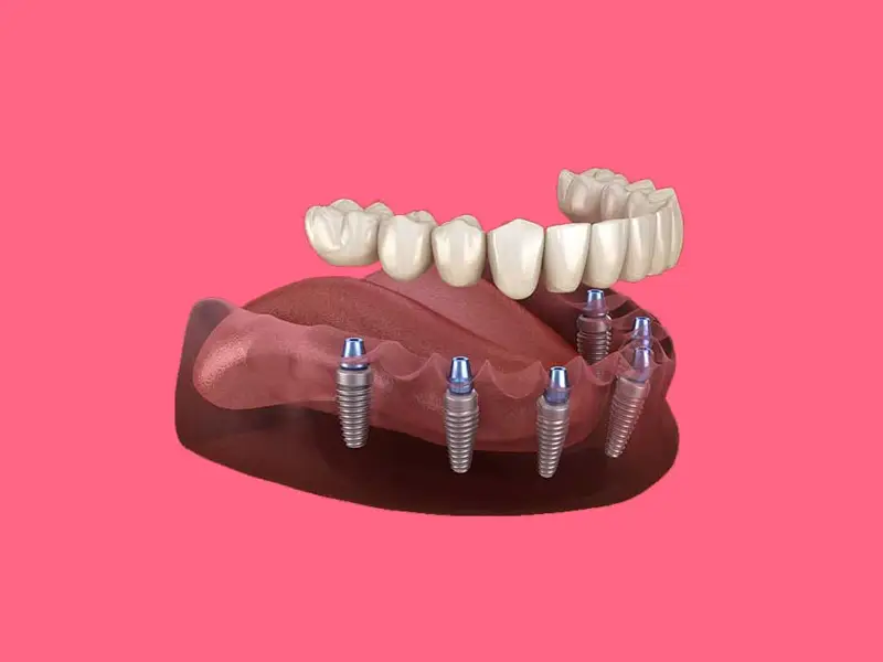 ایمپلنت دندان با بیهوشی در اهواز