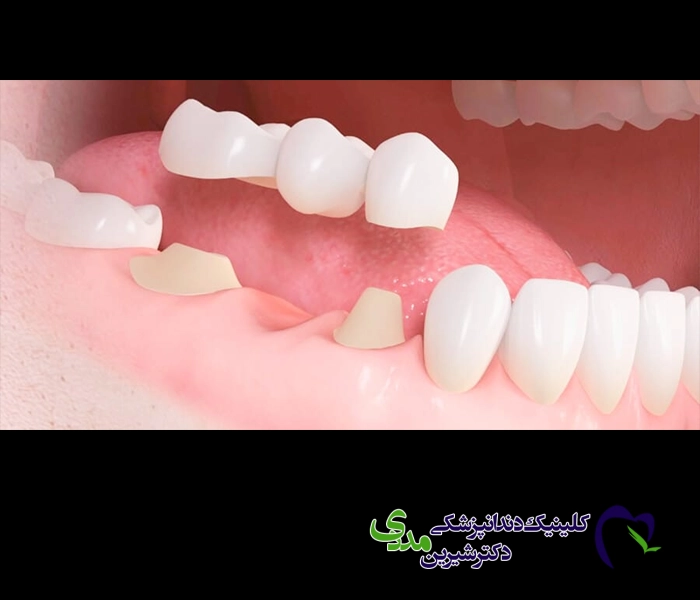 چه افرادی نمی‌توانند از روکش دندان متصل به هم استفاده کنند؟