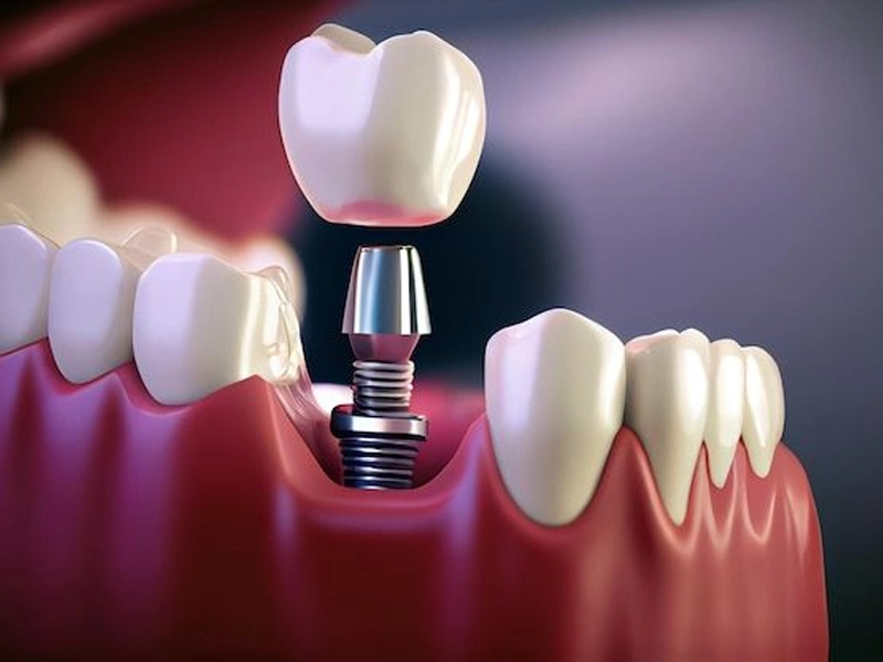 بارگذاری فوری ایمپلنت