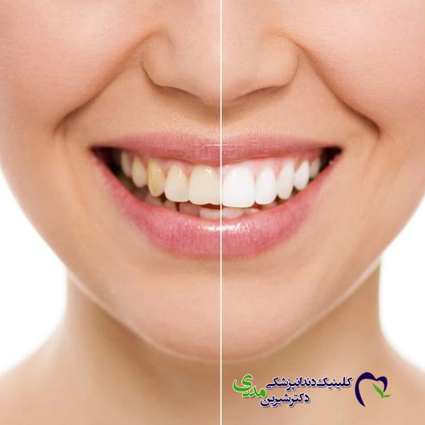 روش‌های بلیچینگ