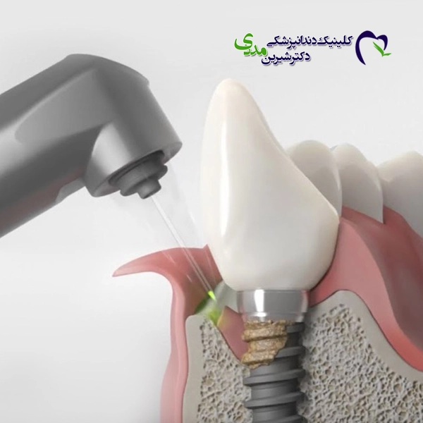 مراحل انجام ایمپلنت فوری با لیزر