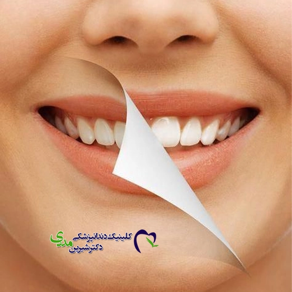 چه کسانی نباید بلیچینگ انجام دهند؟