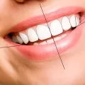 اصلاح طرح لبخند هالیوودی در اهواز