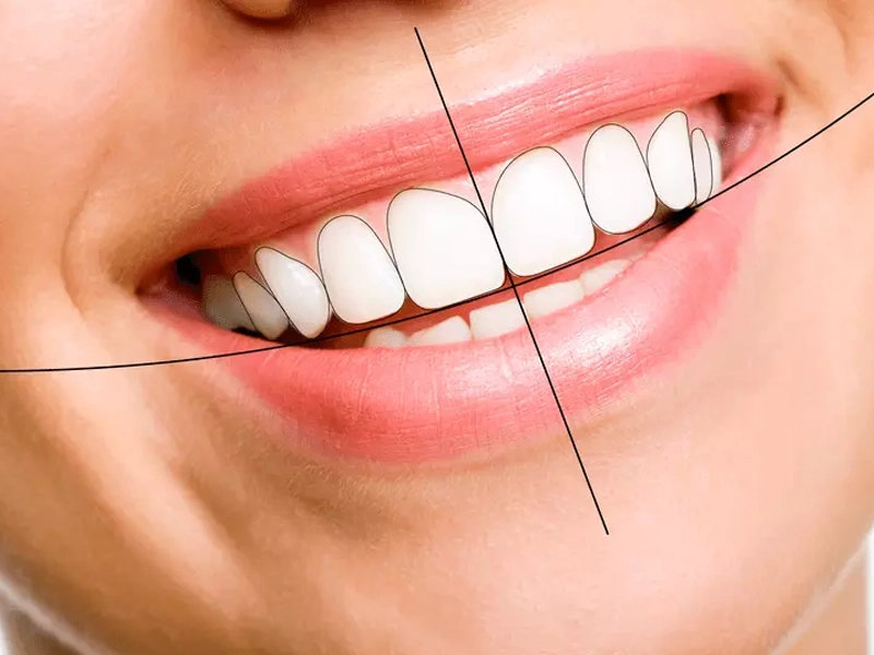 اصلاح طرح لبخند هالیوودی در اهواز