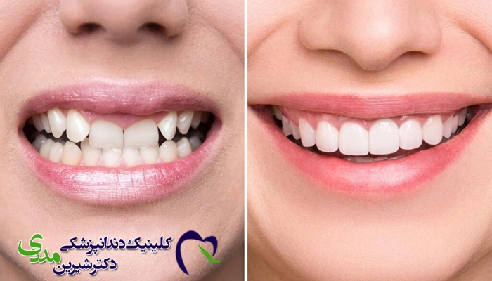 اصلاح طرح لبخند هالیوودی