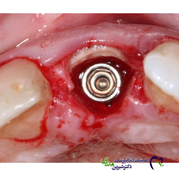 خونریزی پس از جراحی ایمپلنت دندان