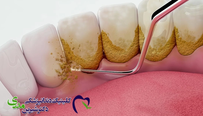 روند کار در جرمگیری دندان