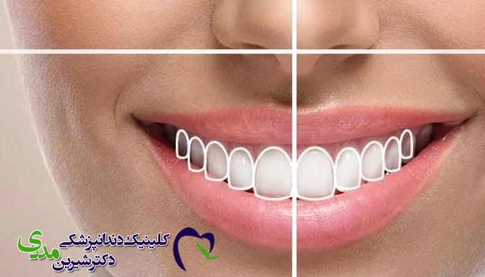 طرح لبخند متناسب با فرم صورت