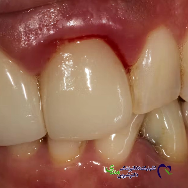 علت خونریزی پس از جراحی ایمپلنت دندان