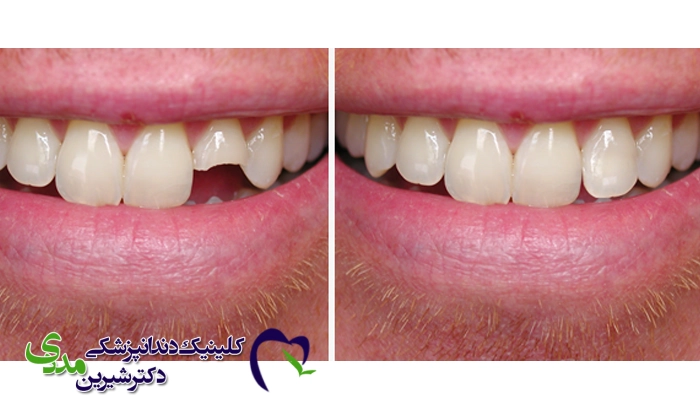 مراقبت از لمینت دندان شکسته  