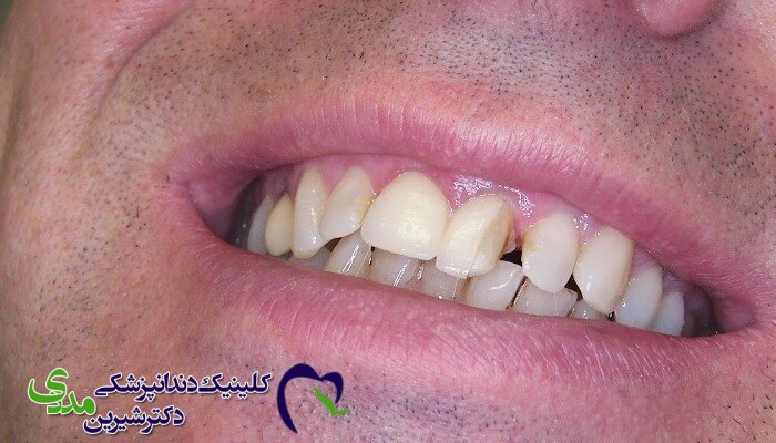 کاربرد لمینت دندان برای ترمیم دندان شکسته  