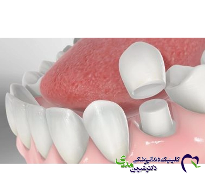 روکش موقت ایمپلنت دندان  