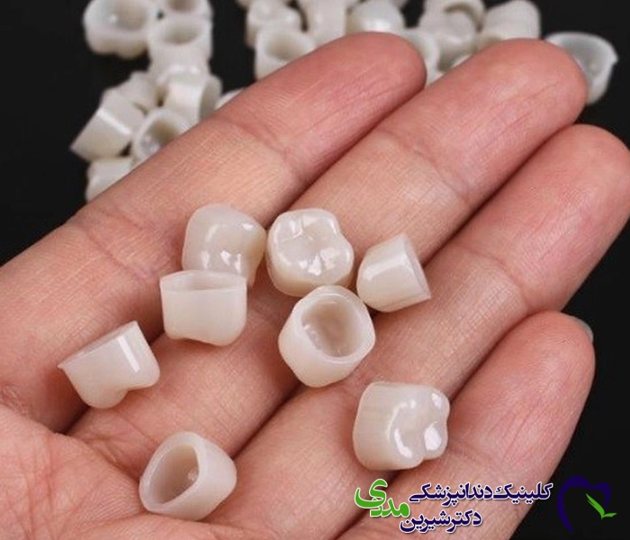 روکش موقت دندان