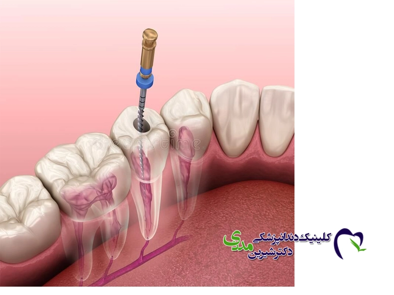 چرا ایمپلنت ‌های دندانی دچار پوسیدگی نمی‌ شوند؟