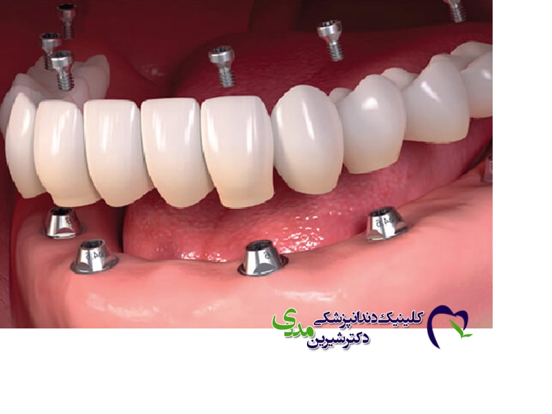 کاشت دندان فوری و یک روزه