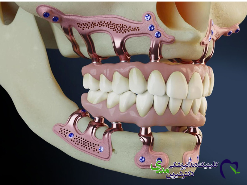 Subperiosteal Implant