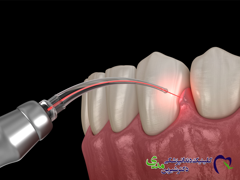 ایمپلنت بدون درد با لیزر