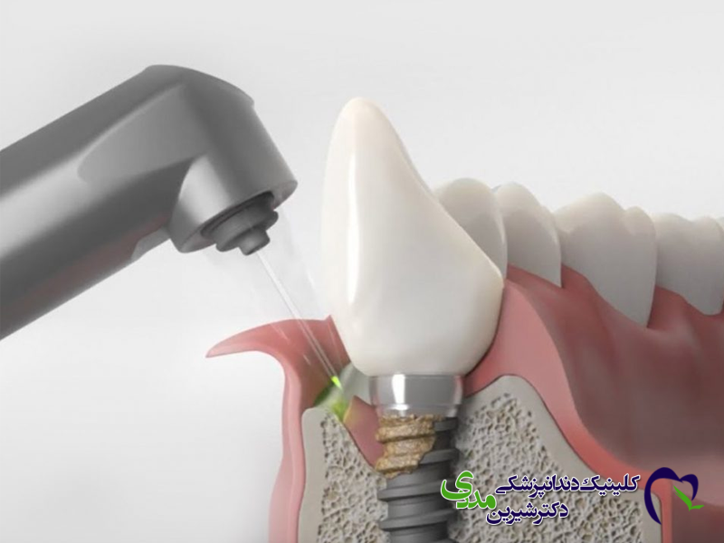 ایمپلنت دندان با لیزر