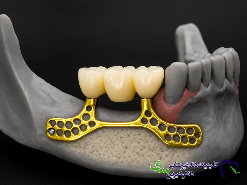 ایمپلنت ساب پریوستئال