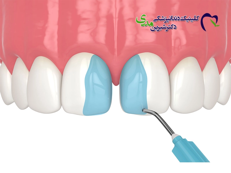 باندینگ دندان 