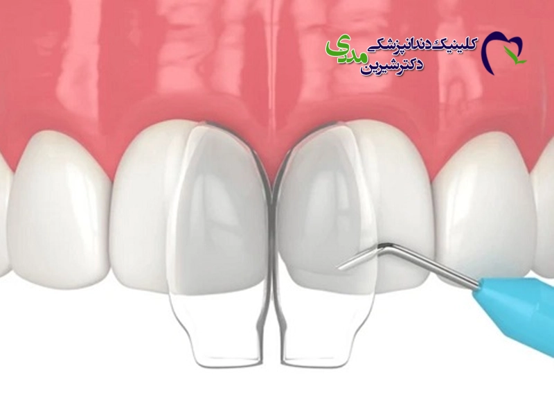 مراقبت ‌های بعد از باندینگ دندان