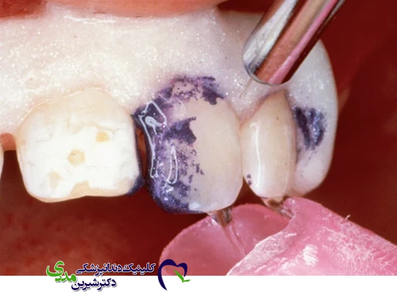 مشکلات سطحی مینای دندان