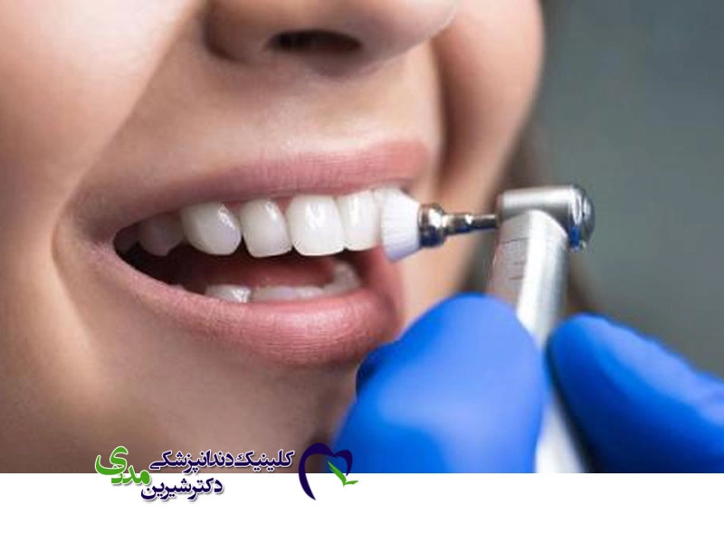 میناکاری دندان