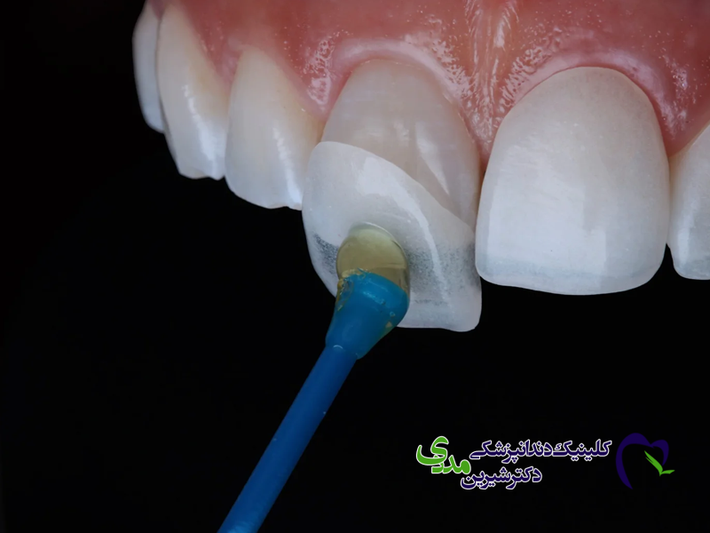 لمینت کریستالی دندان چیست؟
