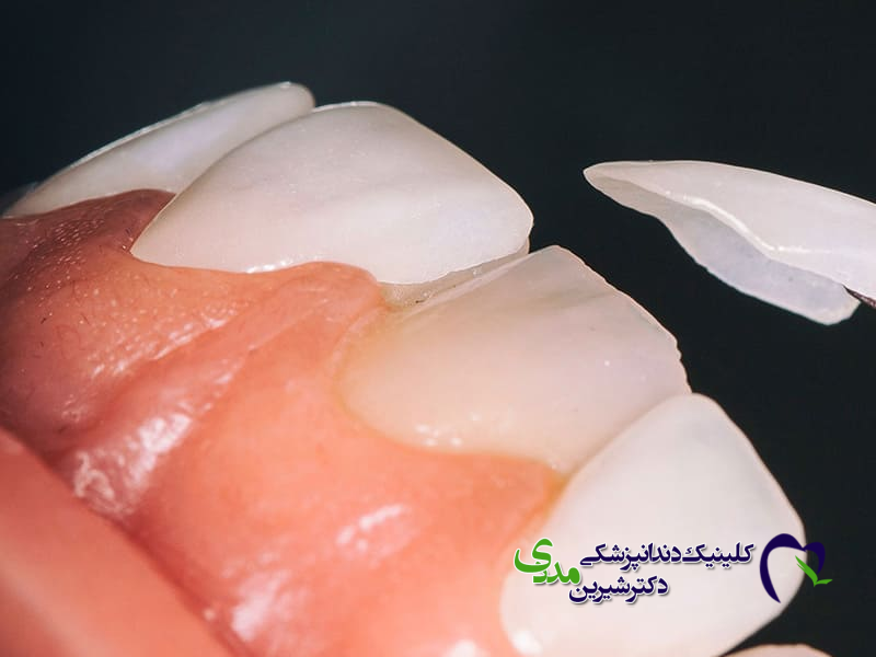 لمینت کریستالی