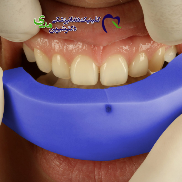 موکاپ دندان