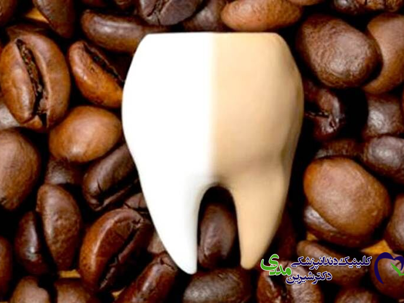 قهوه و چای بر رنگ کامپوزیت چه تاثیری دارد؟