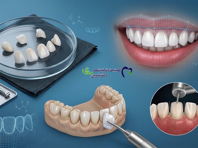 مقدار تراش دندان برای لمینت