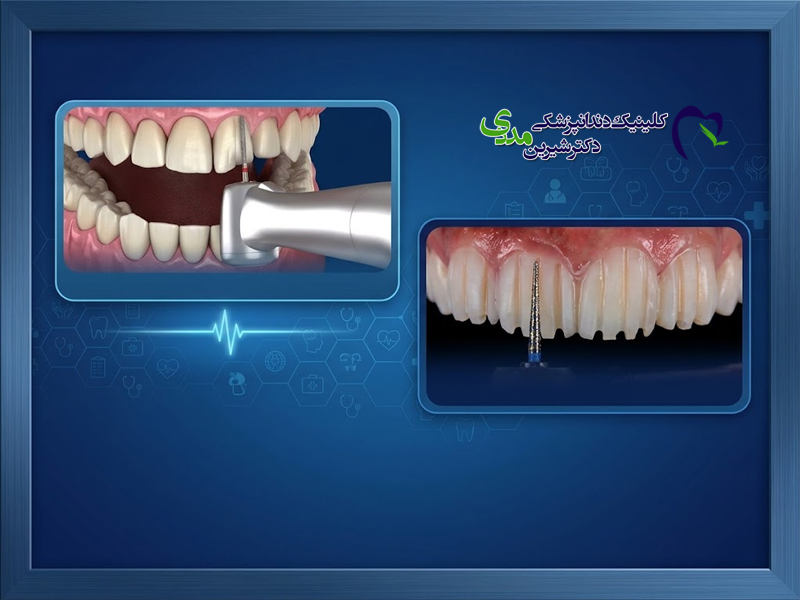  نحوه تراش دندان برای لمینت